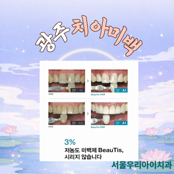 광주 치아미백 전문가용 치아미백으로 치아시림 걱정없는 치아미백은