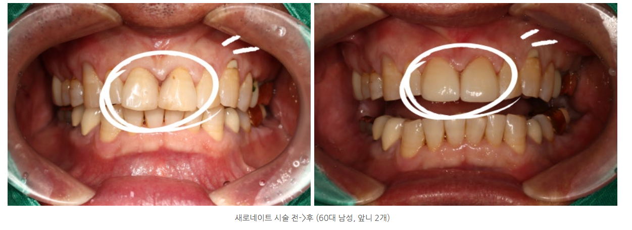 라미네이트 치료가 가능한 나이가 몇살까지 일까요? 중년 라미네이...