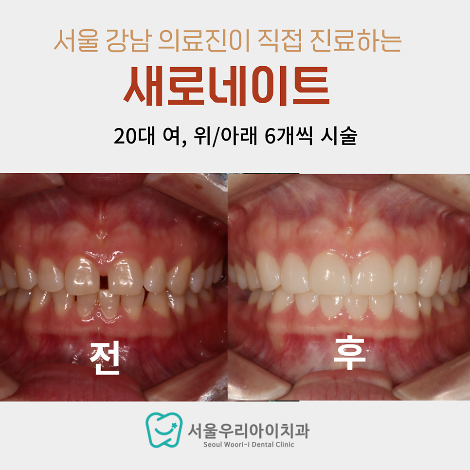 광주 라미네이트 잘하는 치과 어디일까요?