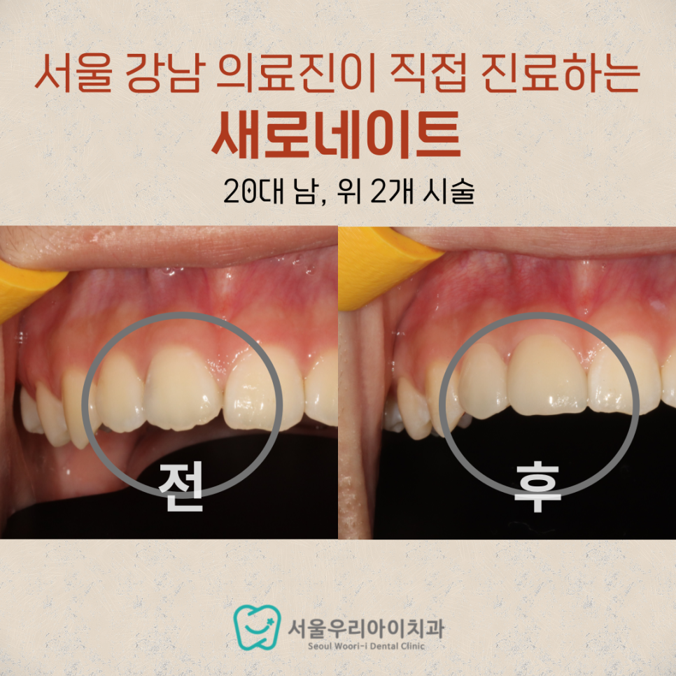 무삭제 라미네이트가 가능할까요?