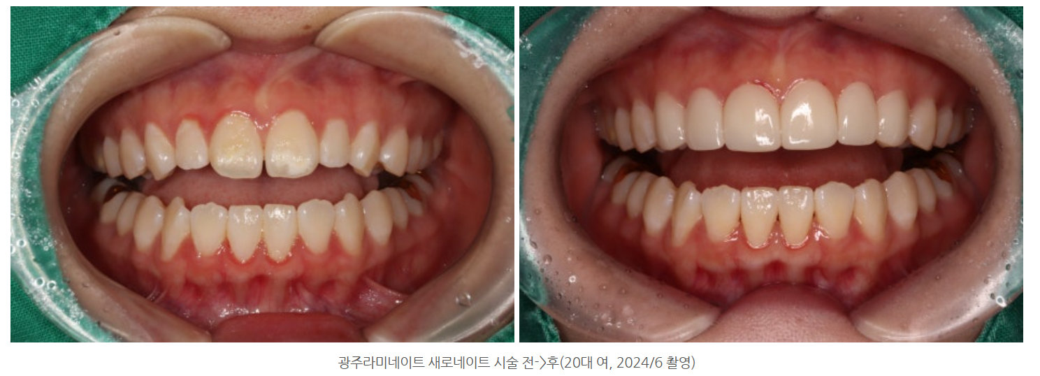 앞니 색깔이 변하는 이유는? 까맣거나 누렇게 변한 앞니를 해결하...