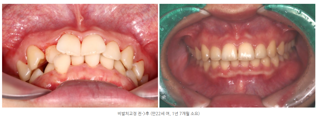 단안모를 개선할 수 있는 교정치료 방법을 광주교정치과에서 알려드립니다