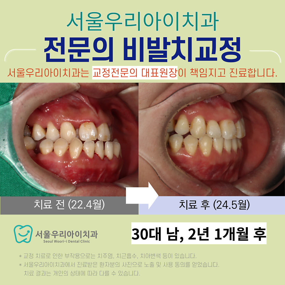 발치나 양악수술이 절대 싫은 경우에는 치아교정을 어떻게 할까요?