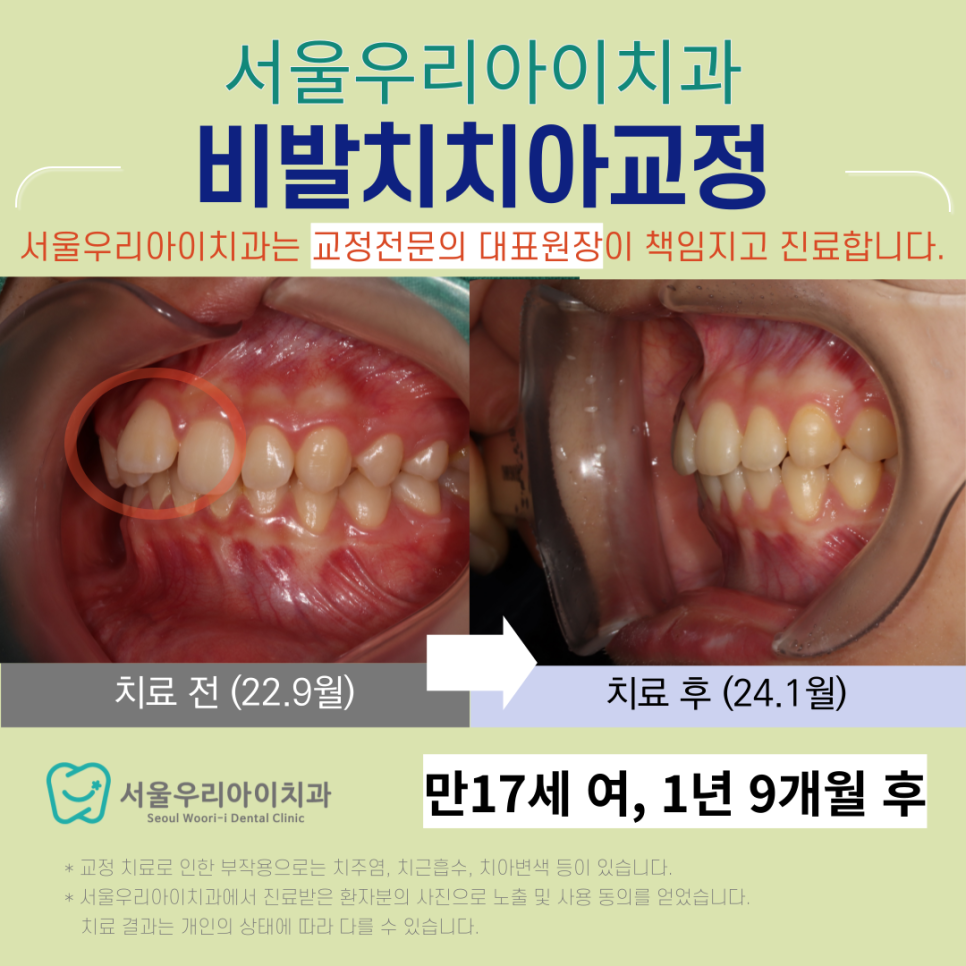 앞니가 튀어나왔을 때 치아교정을 할 수 있나요?