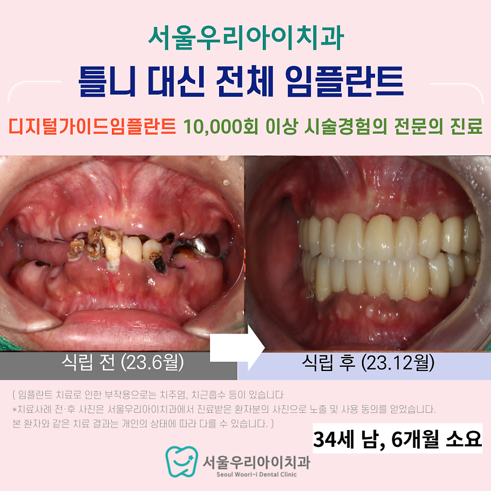 광주 광산구에서 틀니 대신 임플란트 식립이 가능한 치과는?