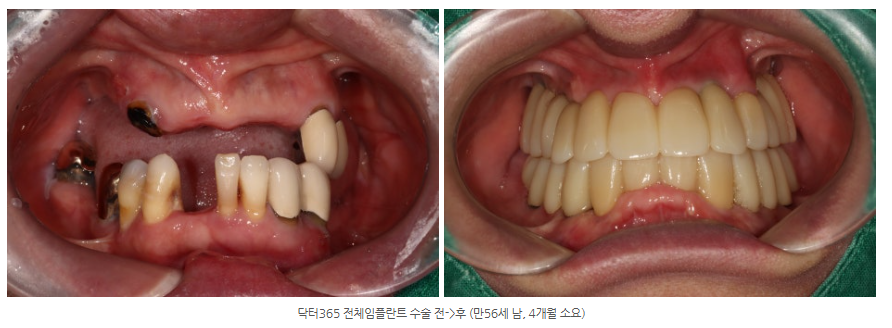 광산구 닥터 365 치과에서 전체 임플란트를 완성한 사례는?
