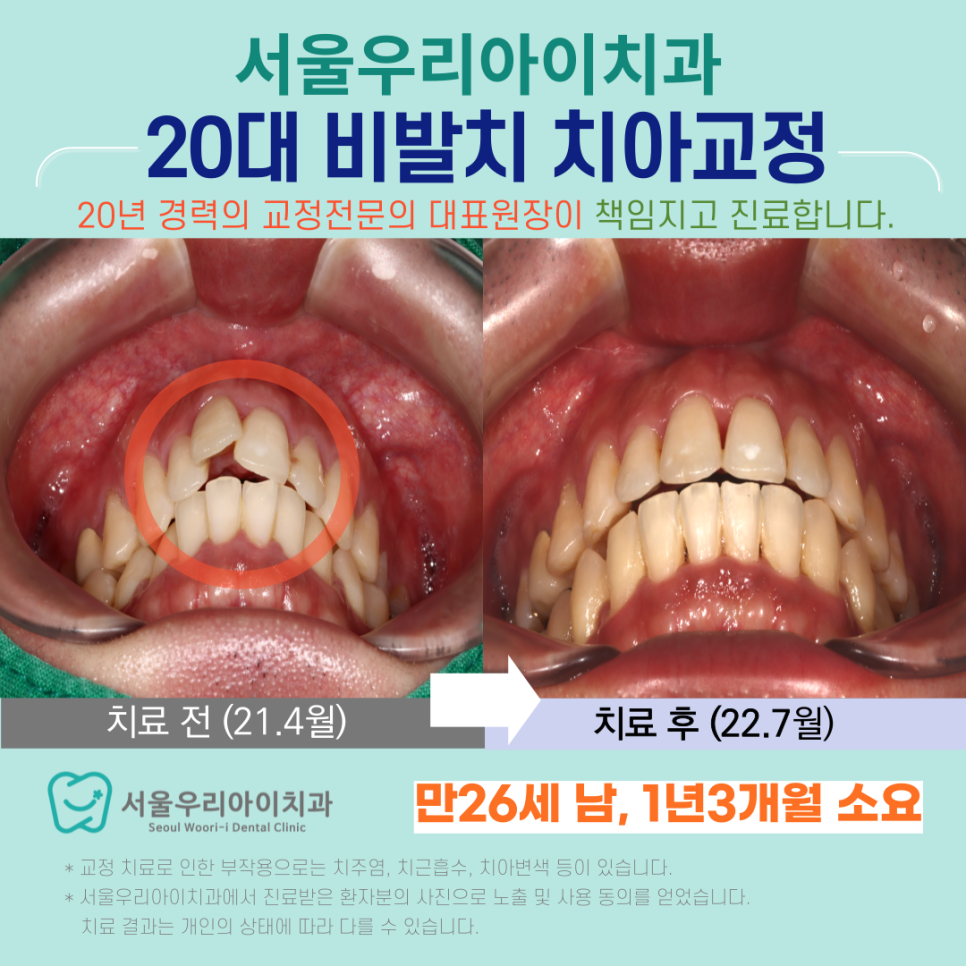 광산구 교정치과 20대 남자 비발치 치아교정 가능한가요?