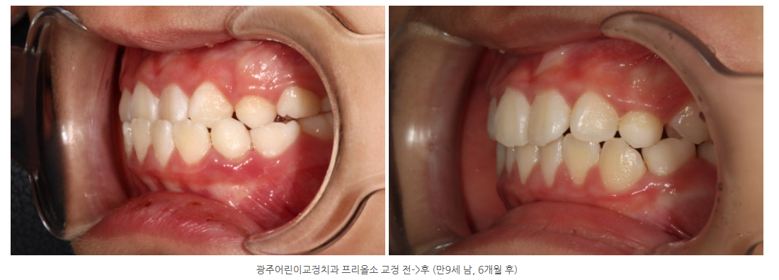 프리올소 3년 후 정기검진 사례로 보는 프리올소 사용 효과