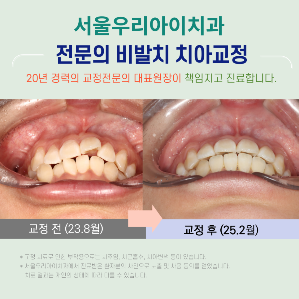광주에서 비발치치아교정으로 교정전문의가 진료하는 치과를 찾는다면?