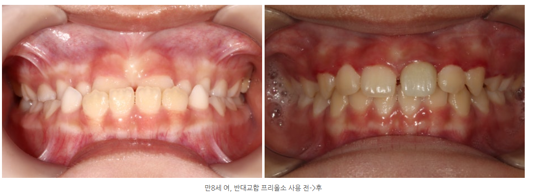 프리올소 교정장치를 가장 많이 사용하는 곳은 어디일까요?
