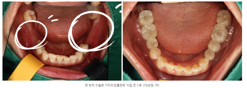 수완지구 원데이 임플란트로 치과에 가기 번거로움을 해소할 수 있다면