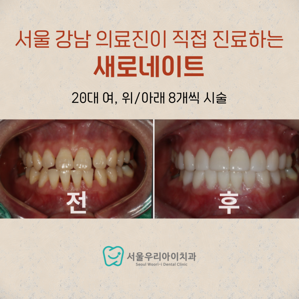 광주 라미네이트 치아변색을 반영구치아미백으로 해결해요