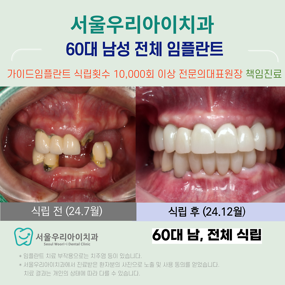 광주 디지털 임플란트가 무엇일까요? 전체 가이드 디지털 임플란트...