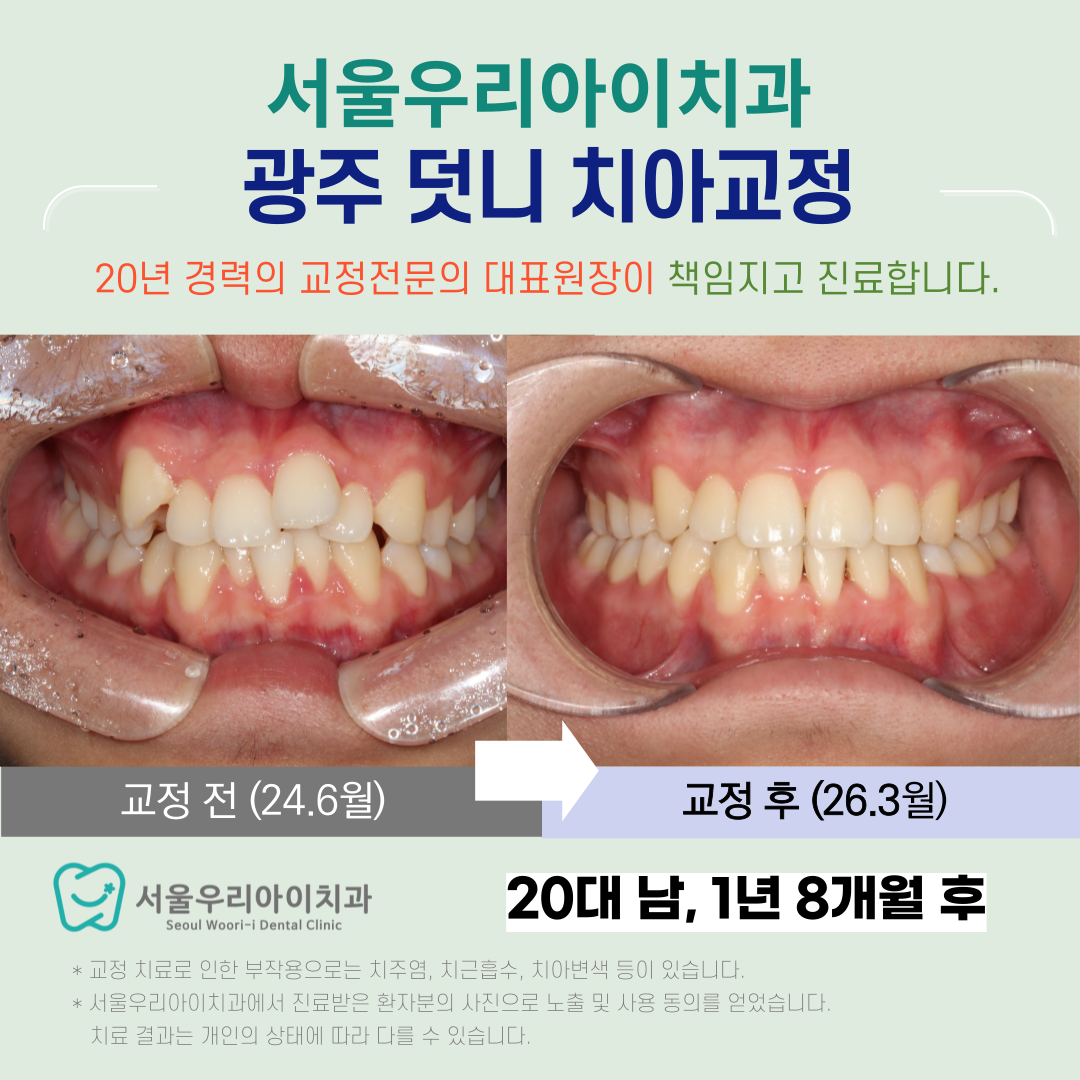 광주 덧니교정 수완지구 교정치과에서 실력있는 교정전문의 진료로