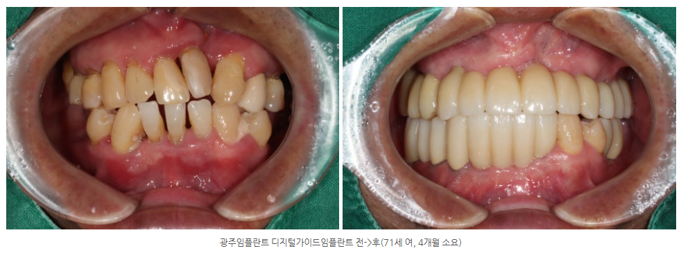 영광 임플란트 치과를 찾기 위해 검색하시다가 방문한 70대 고객...