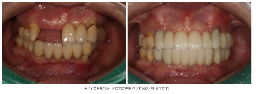 광주 수완지구 임플란트 잘하는 병원을 찾는다면?