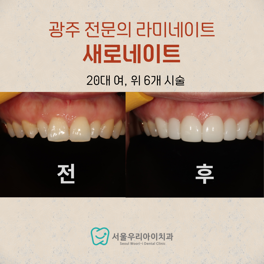 광주 라미네이트 치과에서 치아 크기가 작은 왜소치를 해결하고 싶...