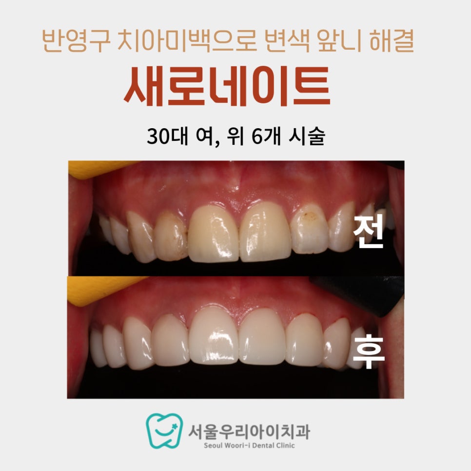 앞니에 반점이 있다면 라미네이트 치료를 통해 개선할 수 있습니다