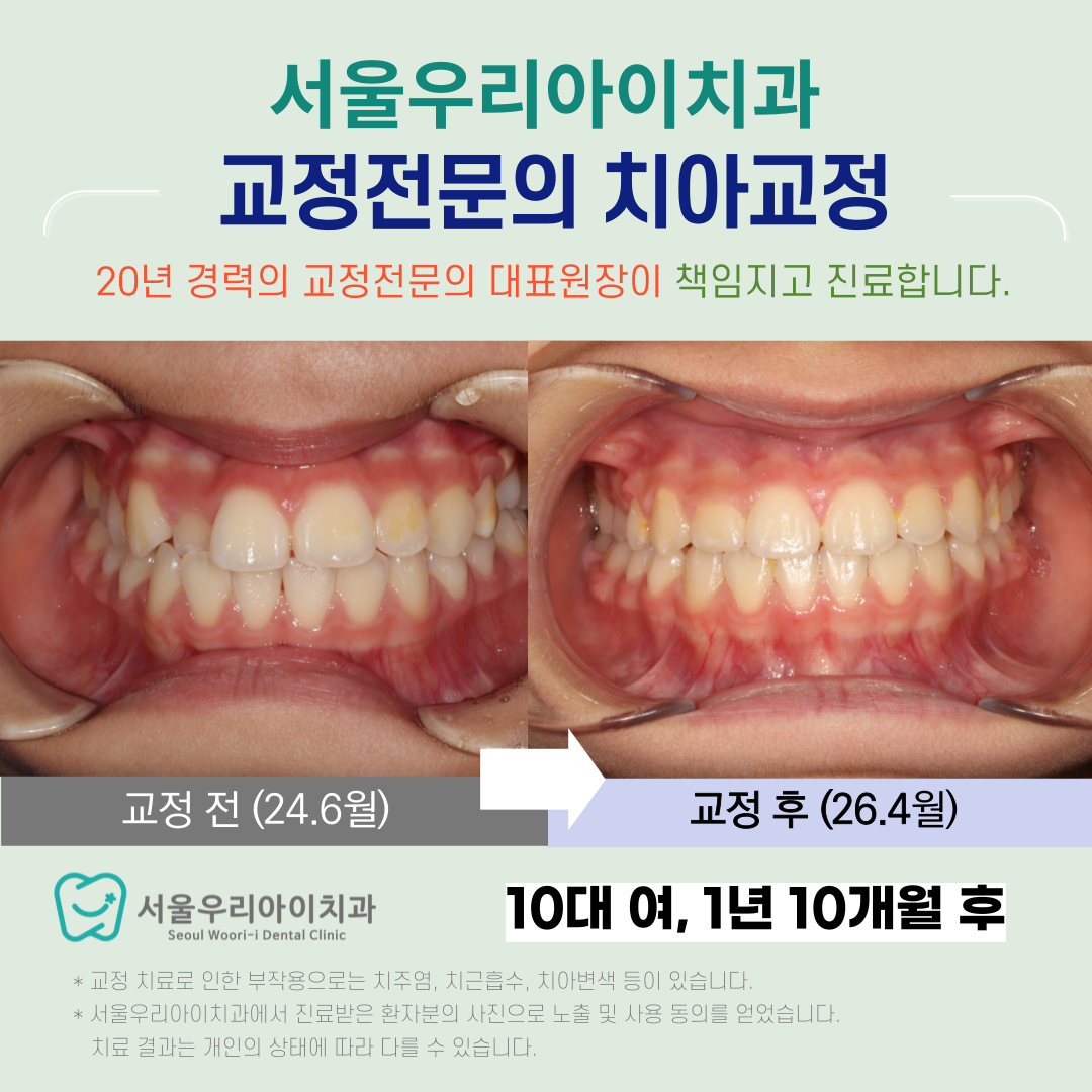 광주 교정전문 치아교정을 전문가에 맡겨야 하는 이유는