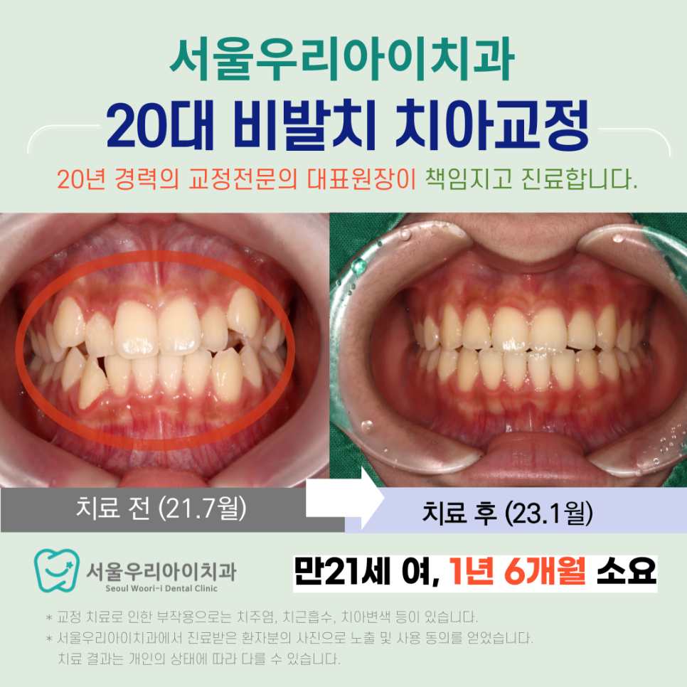 광산구교정치과 비발치교정으로 치료할 수 있는 케이스는?