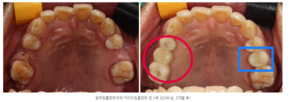 광산구 수완지구에서 뼈가 부족한 임플란트를 심을 때 전문의 진료는?