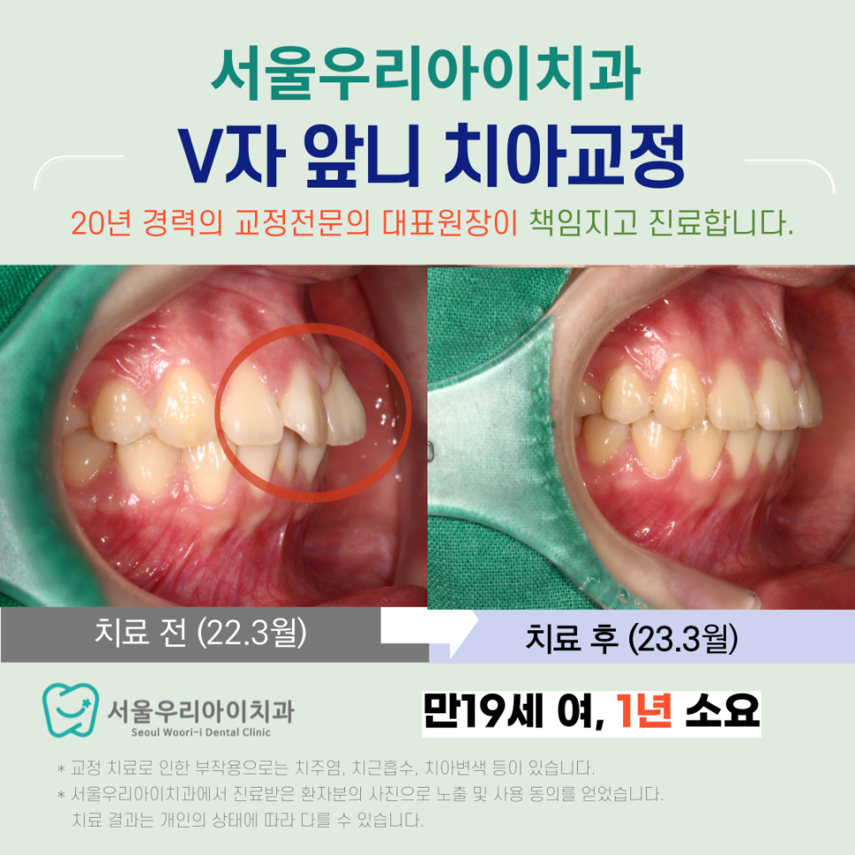 광산구교정치과 수완지구교정치과에서 V자 앞니 해결하는 방법