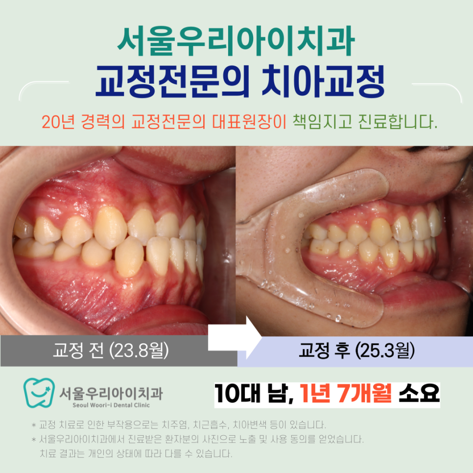 양악수술 없이도 반대교합을 해소할 수 있는 방법이 있을까요?