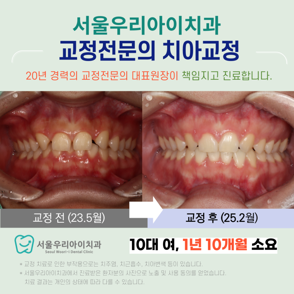 광산구에서 치아 사이 빈 공간을 해결할 수 있는 비발치교정 교정...