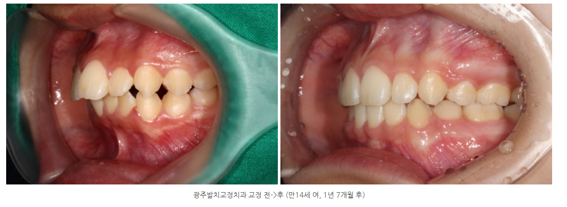 광주발치교정 나주에서 방문하신 돌출입 교정 사례가 궁금하다면?