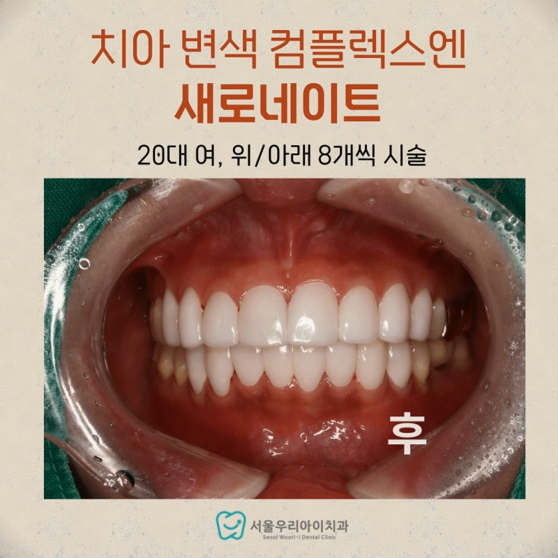 광주 연예인 라미네이트 잘하는 치과 알려주세요