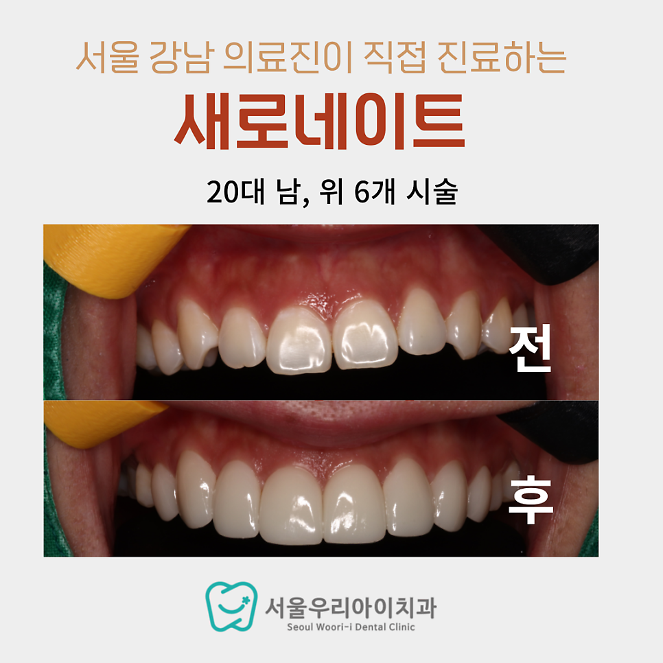 앞니가 작아서 스트레스인 광주 성인 남녀라면 컴플렉스 해결방법