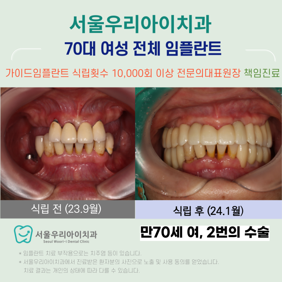 광주광역시에서 60대 이상 70대 환자의 전체 임플란트 가능할까요?
