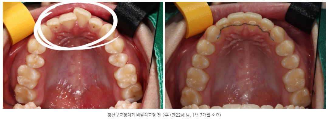 광주광역시 20대 남자 치아교정이 가능한 교정전문의 치과를 찾으세요?