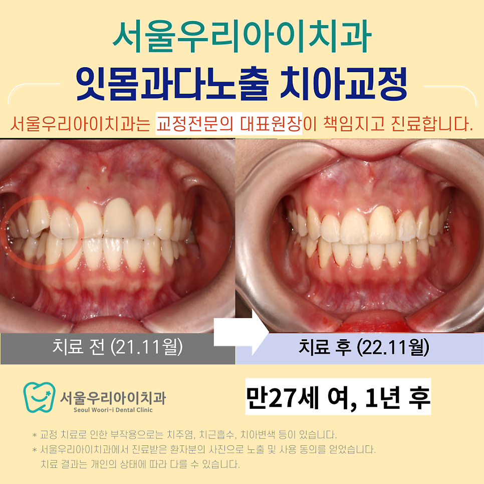 광주 교정전문의 치과에서 20대 여자 치아교정 가능한가요?