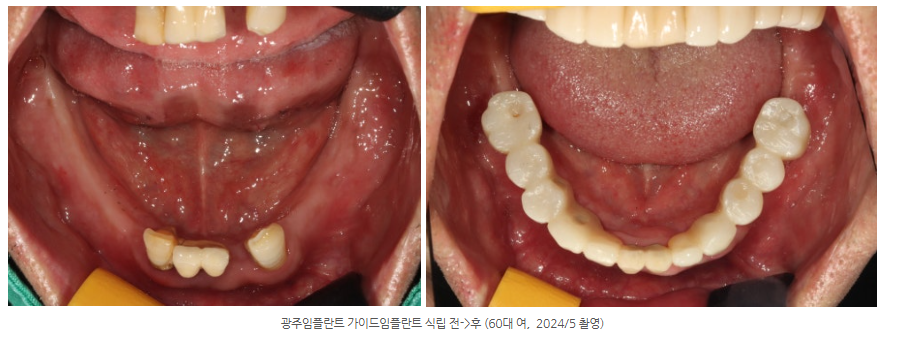 광주에서 디지털 가이드 임플란트 잘하는 치과를 찾는다면?