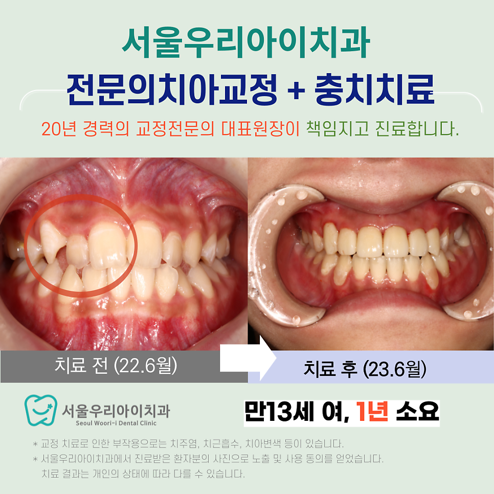 광주교정전문의치과에서 교정전문의치아교정과 전문의충치치료를 같이...