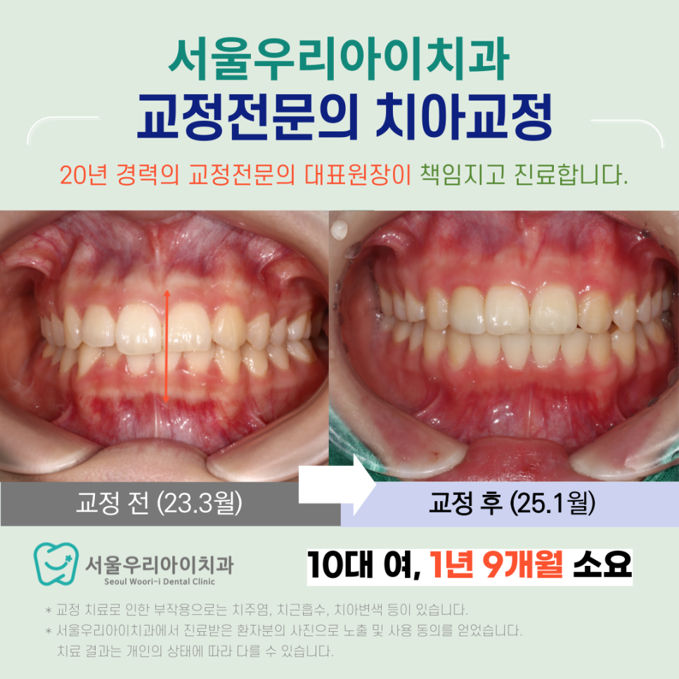 치아 중심선이 무엇인가요? 광주교정치과에서 치아 중심선을 맞추는...