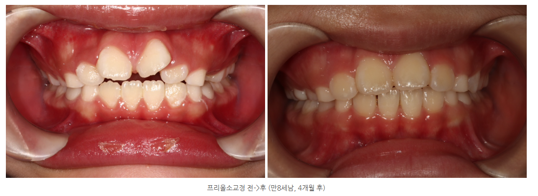 광주 프리올소 유치와 영구치가 교체되는 혼합치열기에 추천