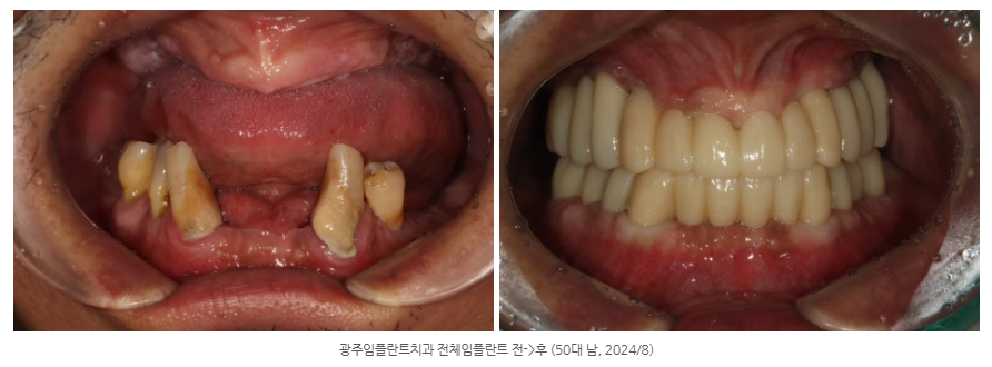 광산구 치과에서 위, 아래 전체 임플란트를 완성하여 새로운 인생...