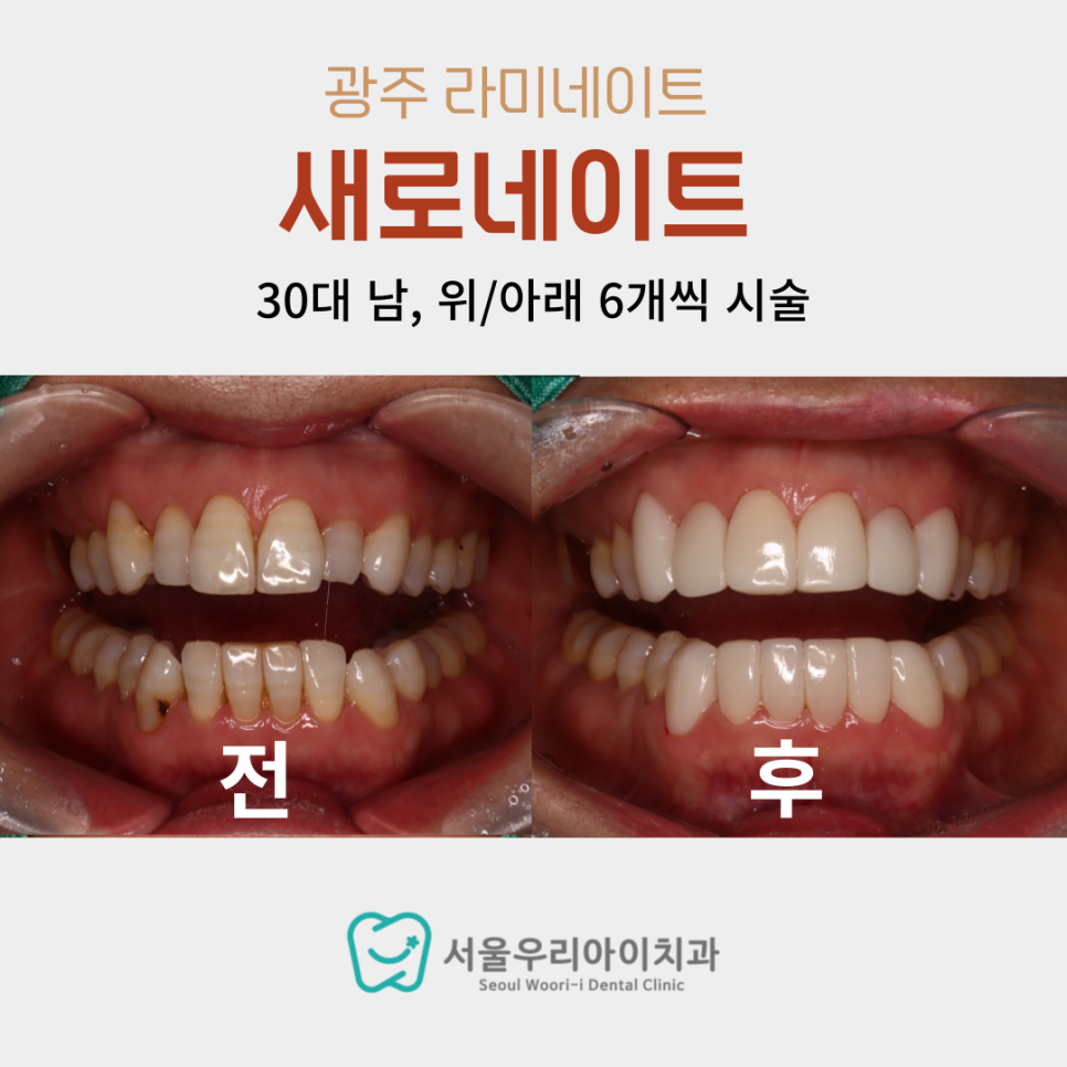 앞니 크기가 서로 다를 때 해결하는 방법이 있나요?