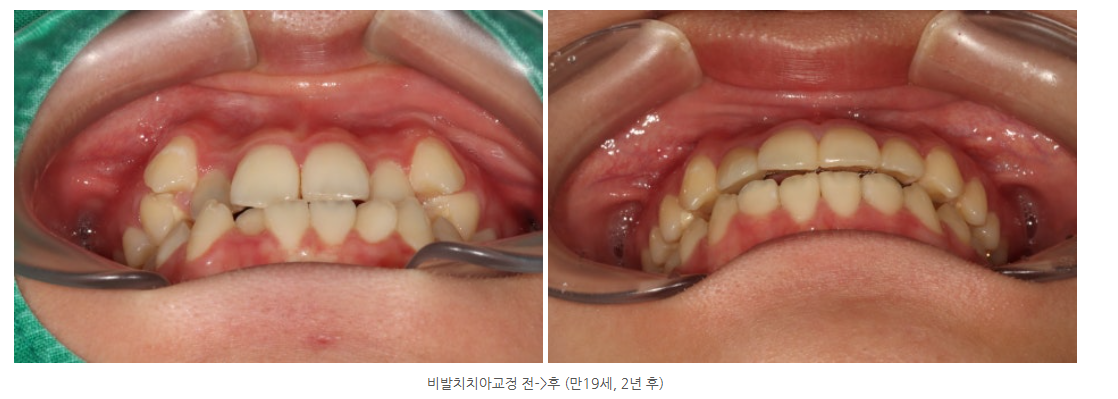 광산구교정치과 양악수술 없이 비발치교정으로 개선하는 방법은?