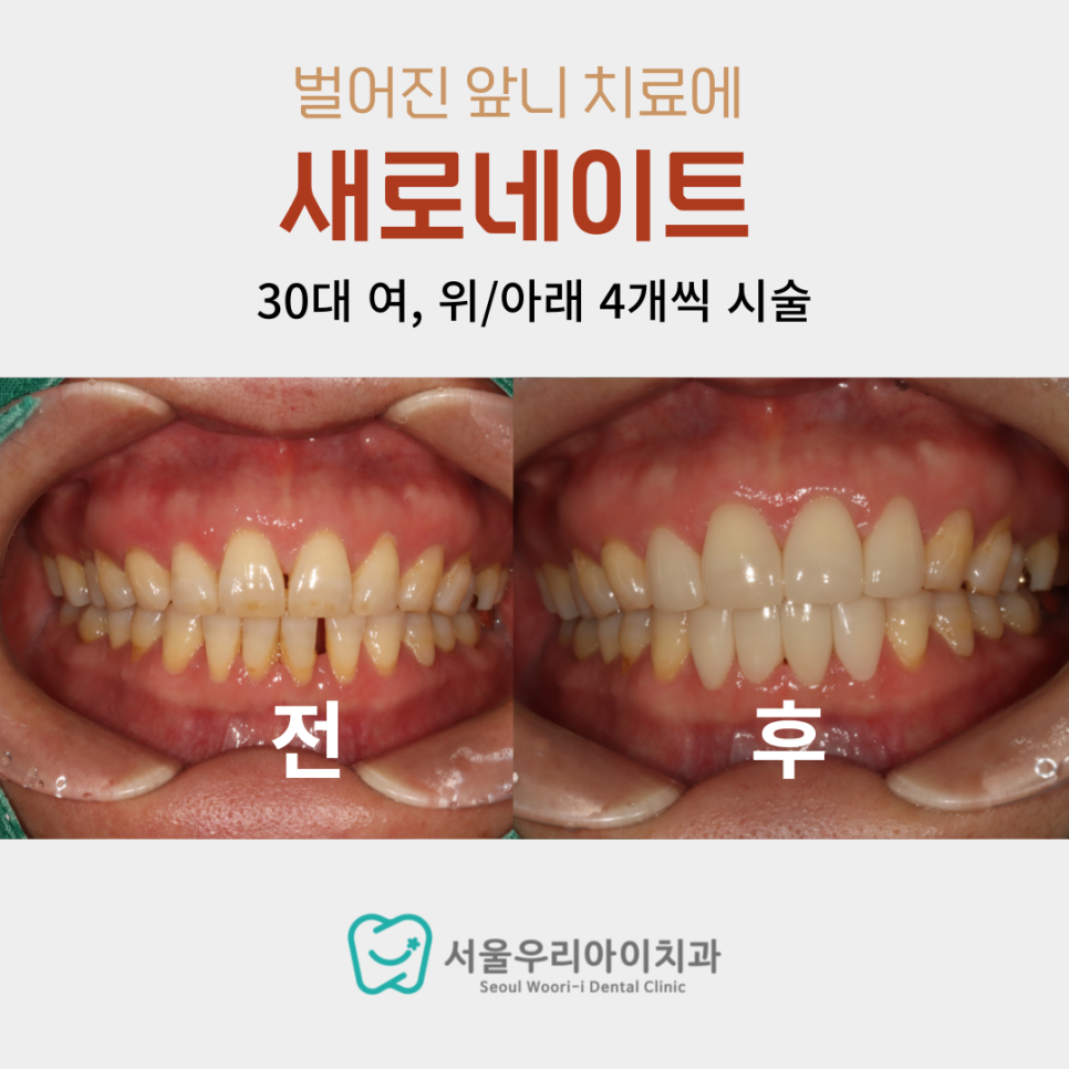 앞니 벌어져서 신경쓰이는 사람 후회하기 싫다면 필독!