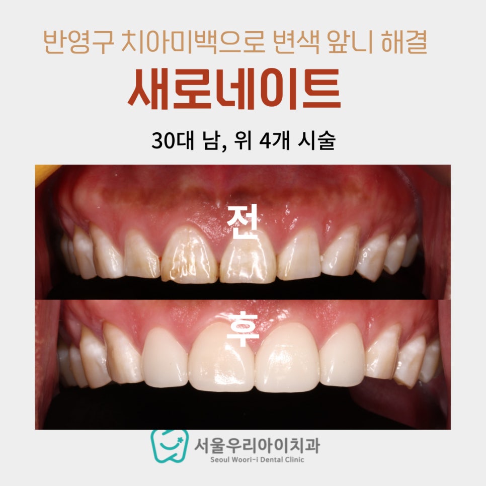 광주에서 윗니 라미네이트 4개만 했는데 바뀐 인상