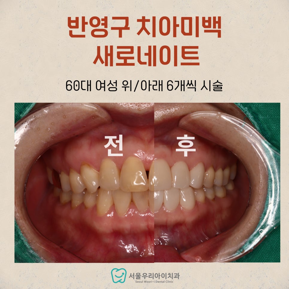 치아가 누래서 스트레스 받는 60대 이상이라면 꼭 읽어보세요