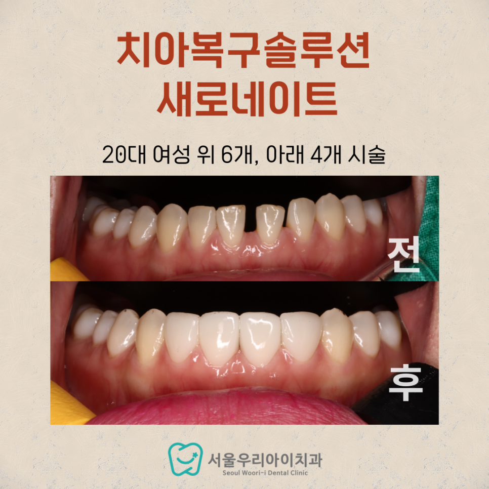 앞니 깨짐, 앞니 벌어짐 때문에 고민인 20대 이상 성인이라면...