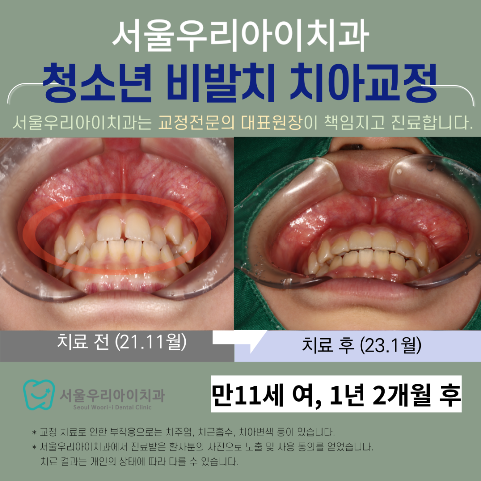 광주 어린이 치아교정 교정전문의 비발치교정치료로