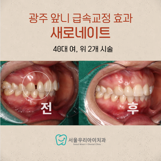 광주 앞니교정 앞니부분교정이나 급속앞니교정을 원할 때는 바로 이...