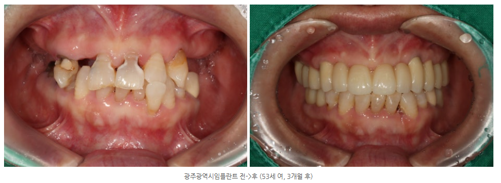 광주 앞니 임플란트 잘하는 치과에서 성공적으로 가이드 임플란트를...