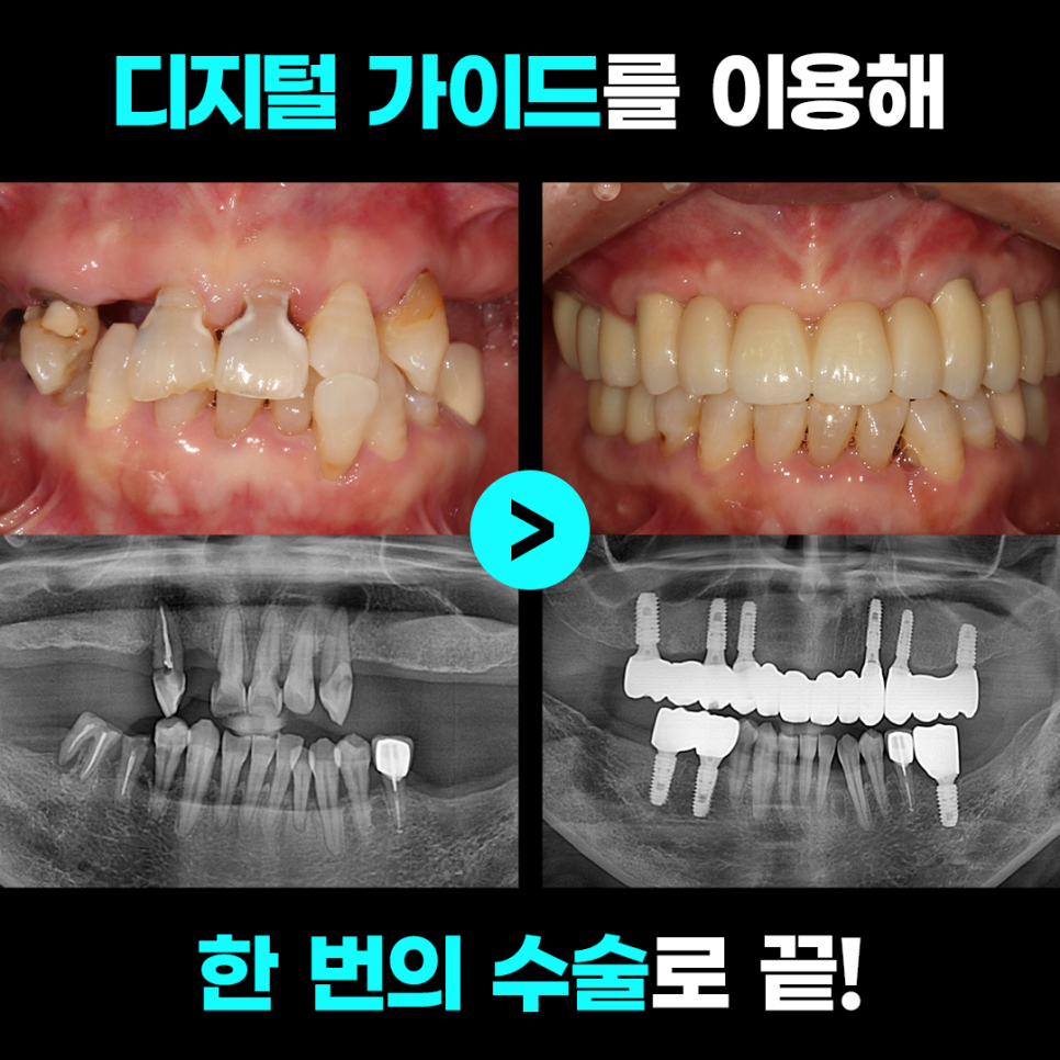 수완지구 임플란트 치과에서 디지털 가이드 임플란트를 이용하여