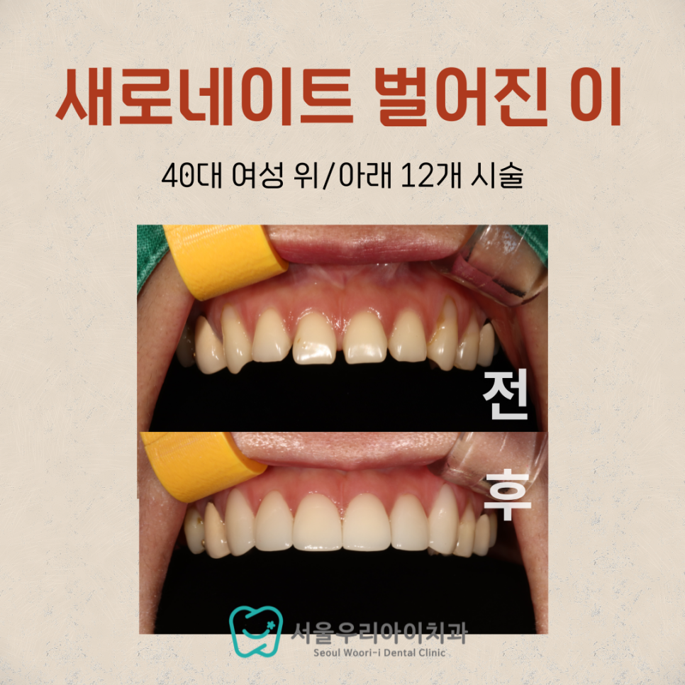 광산구 라미네이트 치과에서 벌어진 앞니를 해결하는 방법 꼭 알아...